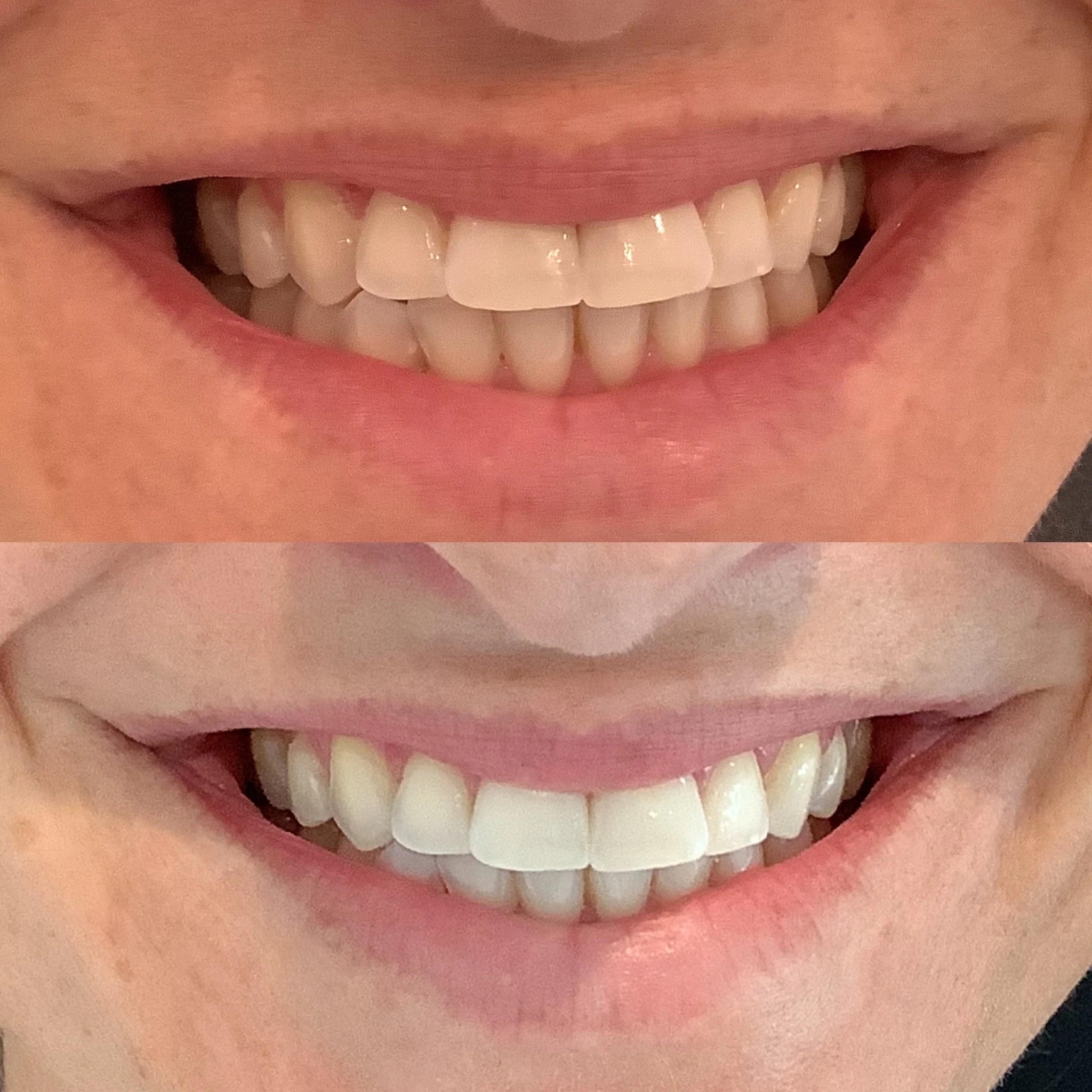 teeth whitening before and after in Phoenix