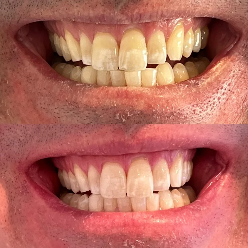 teeth whitening before and after in Phoenix