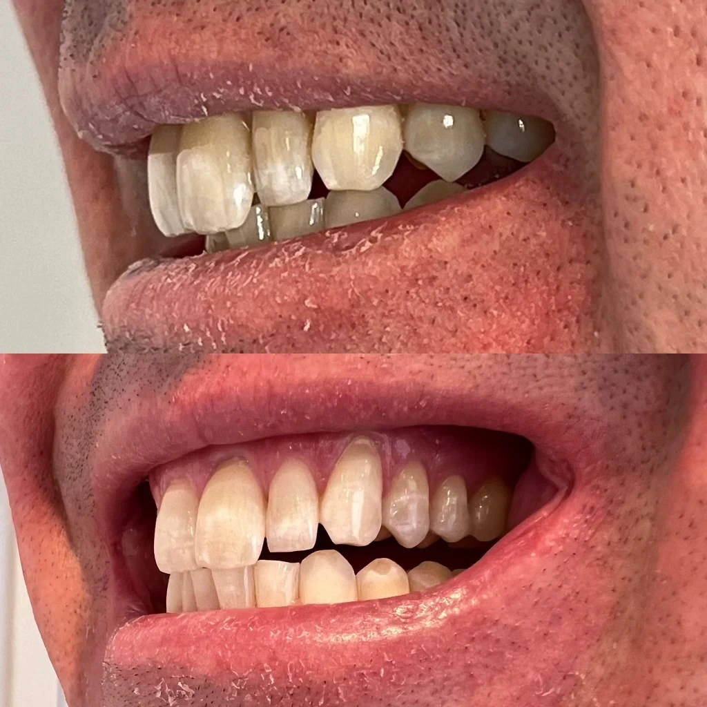 teeth whitening before and after in Phoenix