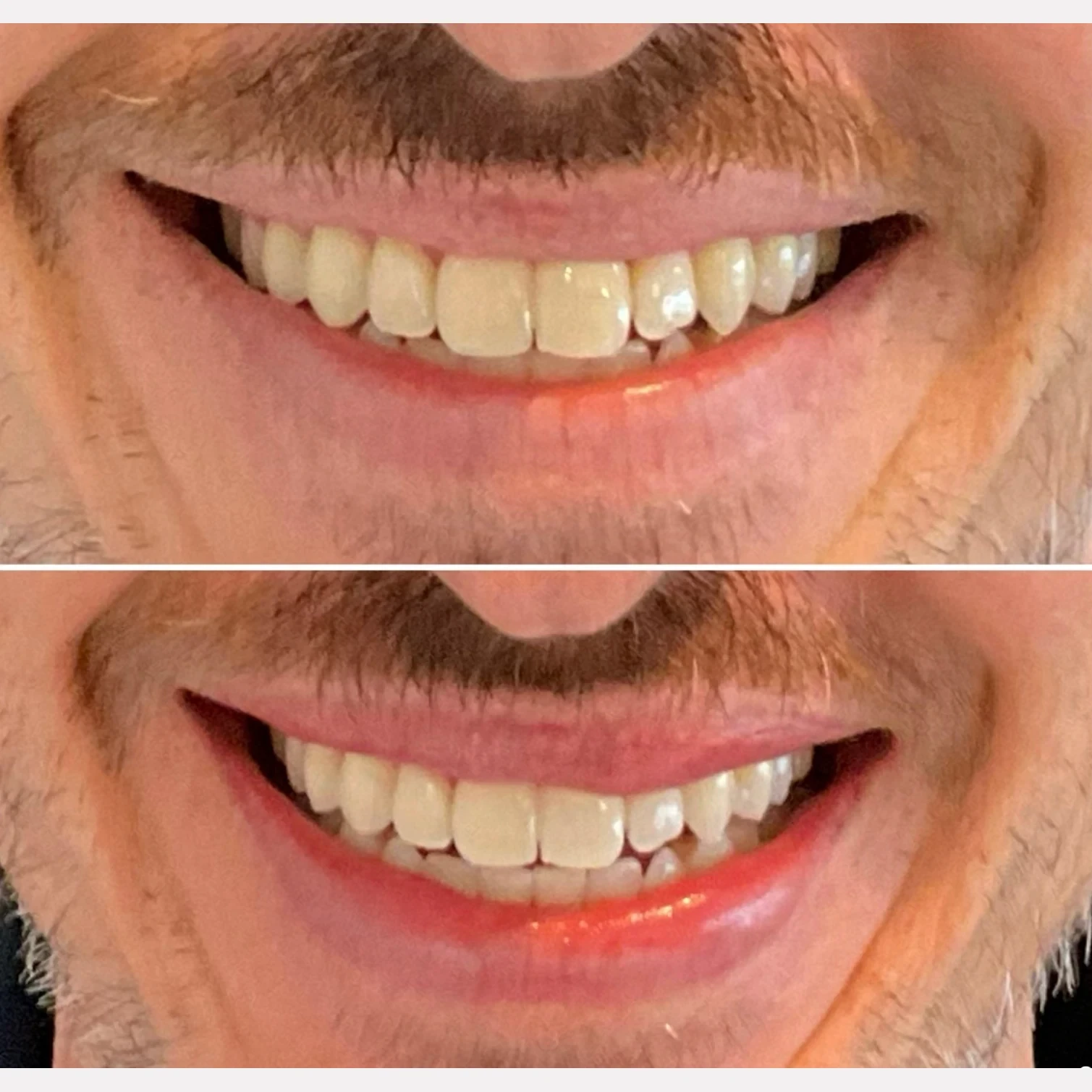 teeth whitening before and after in Phoenix