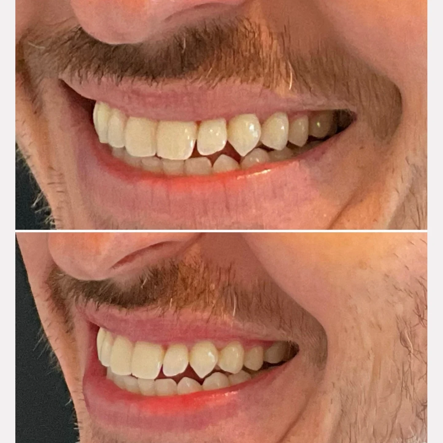 teeth whitening before and after in Phoenix
