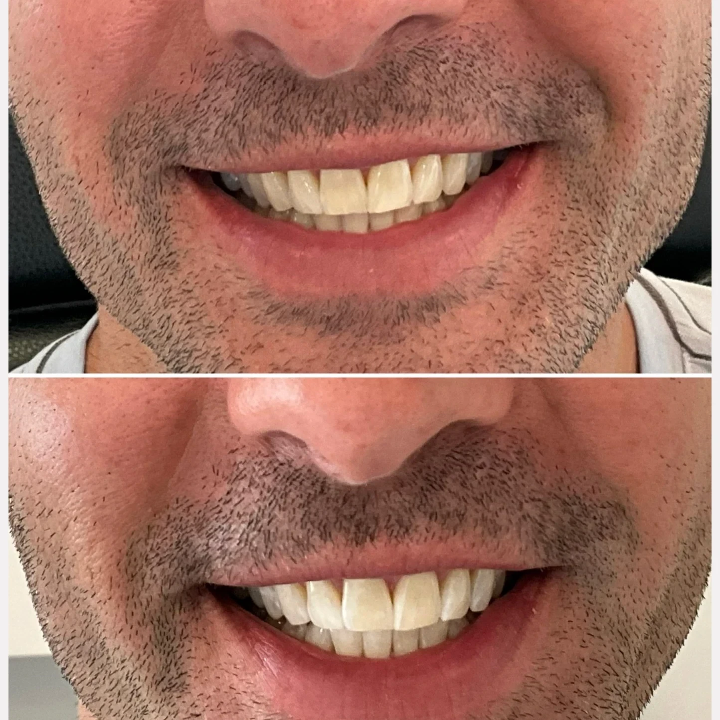 teeth whitening before and after in Phoenix