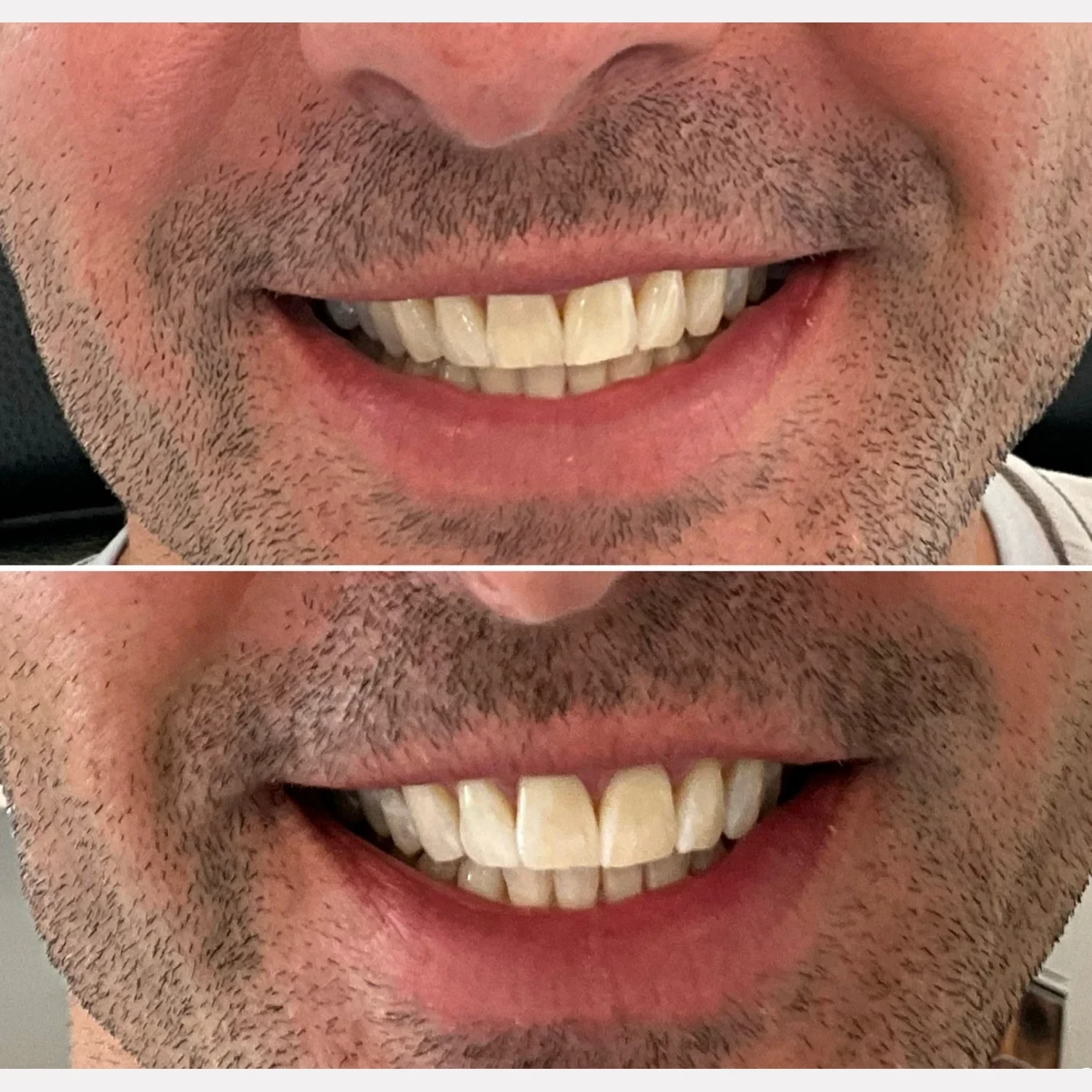 teeth whitening before and after in Phoenix