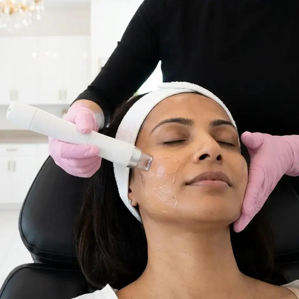 RF Microneedling in Phoenix, AZ