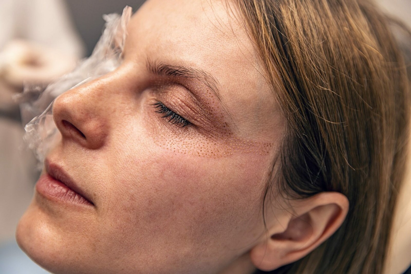 After a plasma fibroblast skin tightening treatment