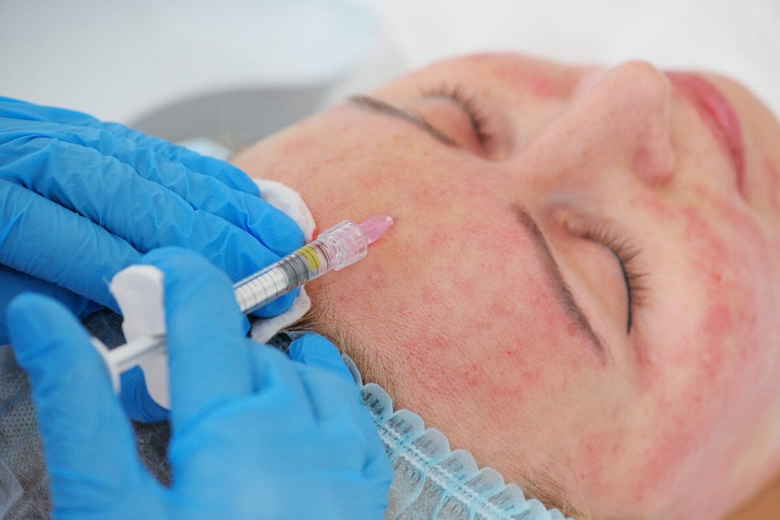 Discover Microneedling with PRP at our Phoenix Med Spa | Rouge & Wright